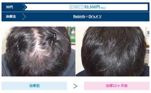 AGAスキンクリニック仙台院の男性薄毛治療症例写真