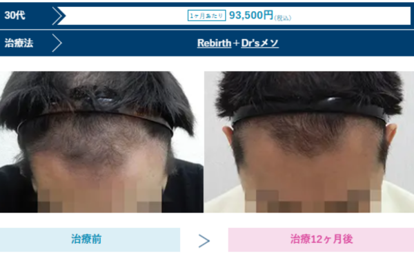 AGAスキンクリニック大宮院の男性薄毛治療症例写真（ビフォーアフターの様子）