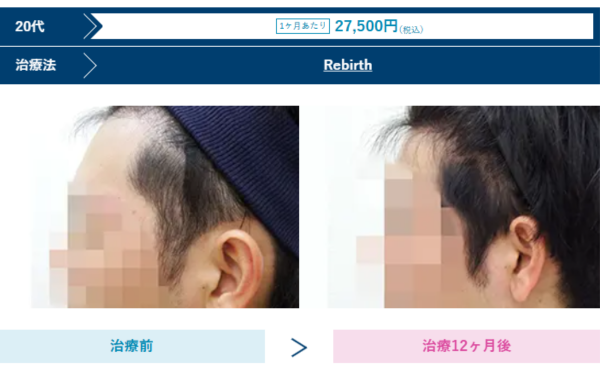 AGAスキンクリニック沖縄院の男性薄毛治療症例写真