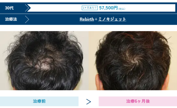 AGAスキンクリニック高知院の男性薄毛治療症例写真