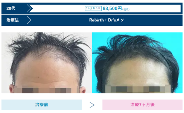 AGAスキンクリニック京都河原町院の男性治療症例のビフォーアフター、20代の写真
