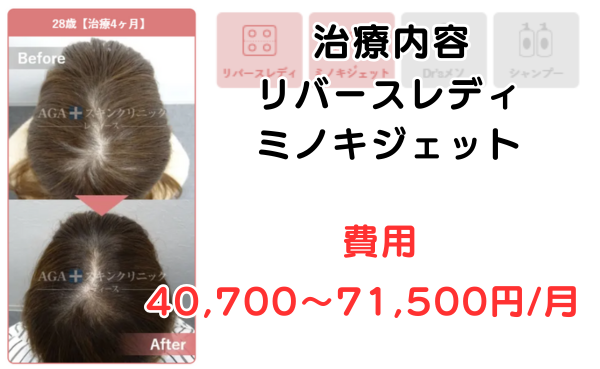 AGAスキンクリニック京都駅前レディース院、20代の治療症例ビフォーアフター