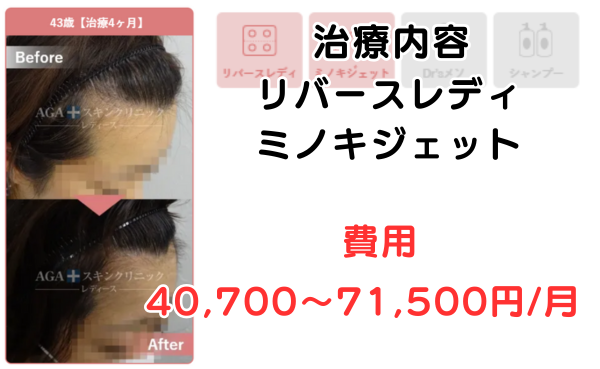 AGAスキンクリニック京都駅前レディース院、40代の治療症例ビフォーアフター1
