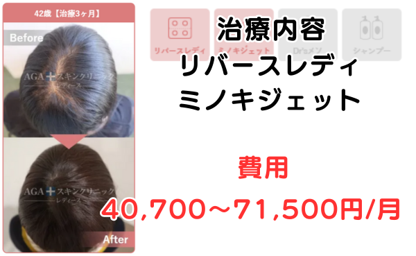 AGAスキンクリニック京都駅前レディース院、40代の治療症例ビフォーアフター2