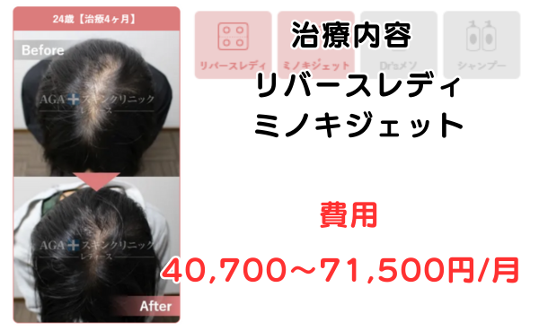 AGAスキンクリニック名古屋レディース院の治療症例24歳治療4ヶ月のビフォーアフター