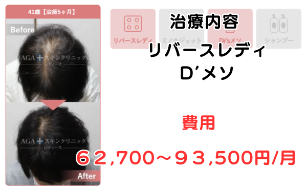 AGAスキンクリニック名古屋レディース院の治療症例41歳治療5ヶ月のビフォーアフター