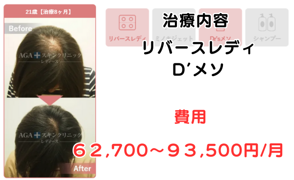 AGAスキンクリニック大阪梅田レディース院の治療症例21歳治療48ヶ月のビフォーアフター