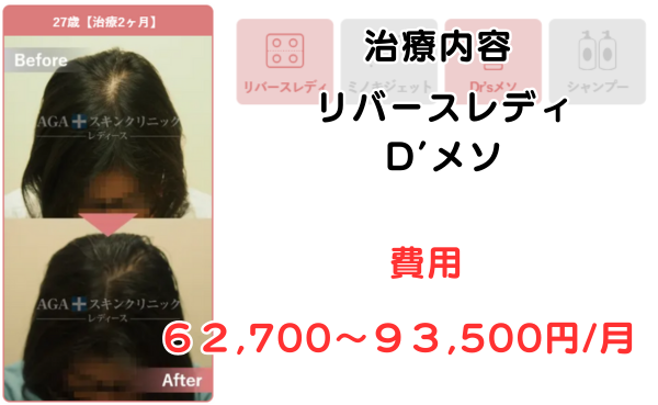 AGAスキンクリニック大阪梅田レディース院の治療症例27歳治療2ヶ月のビフォーアフター