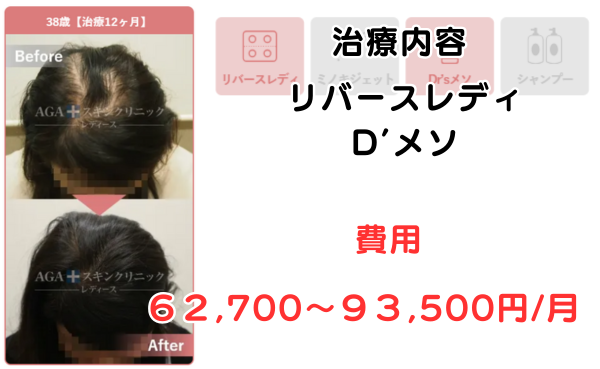 AGAスキンクリニック大阪梅田レディース院の治療症例38歳治療12ヶ月のビフォーアフター