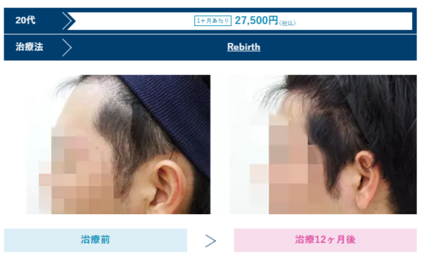 AGAスキンクリニック沖縄院の男性治療症例のビフォーアフター、20代の写真