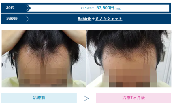 AGAスキンクリニック熊本院の男性治療症例のビフォーアフター、30代の写真2例目